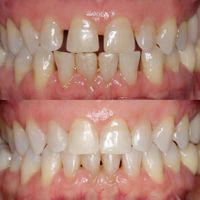 Invisalign 0121